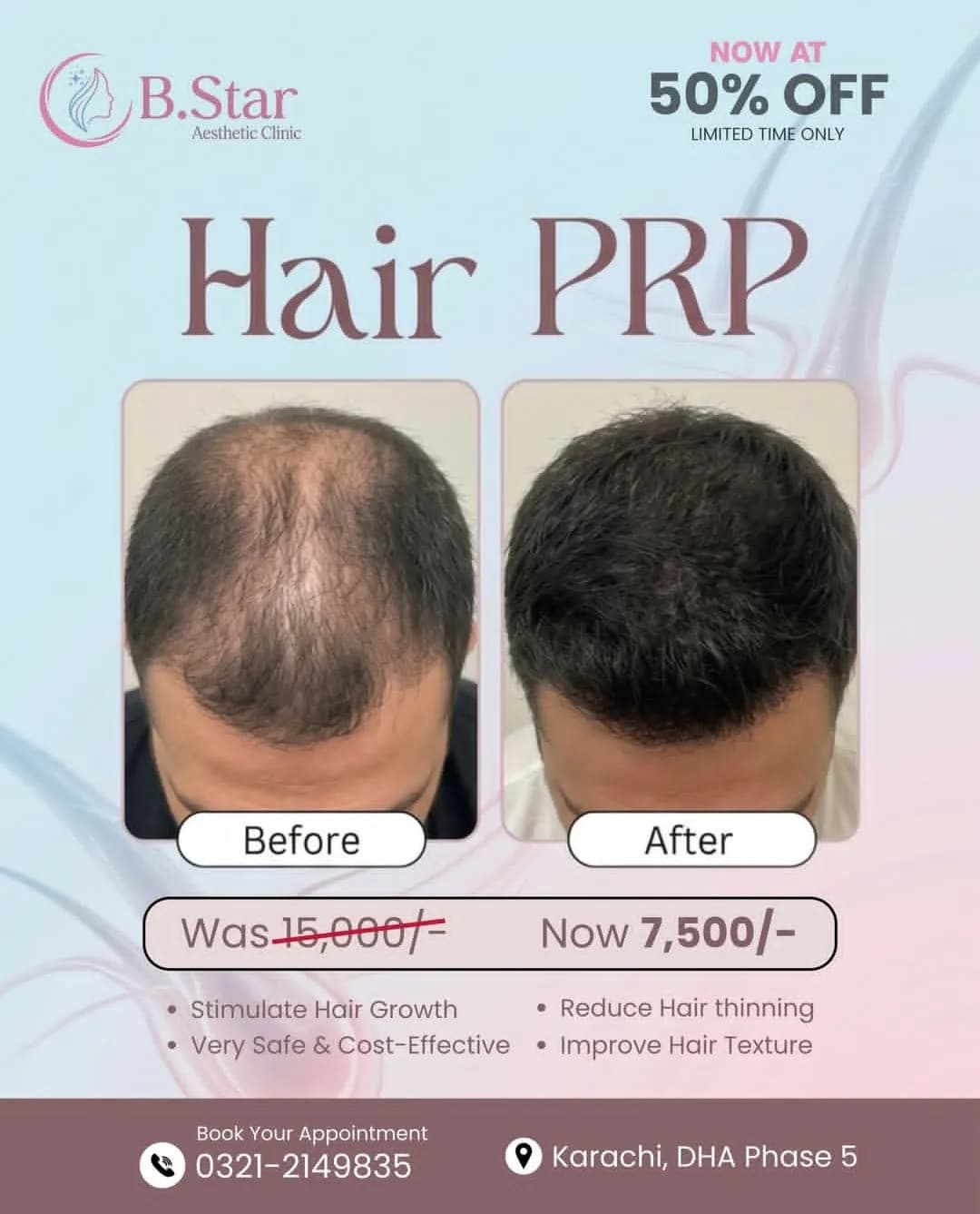 Hair PRP before and after at B.Star Aesthetic Clinic
