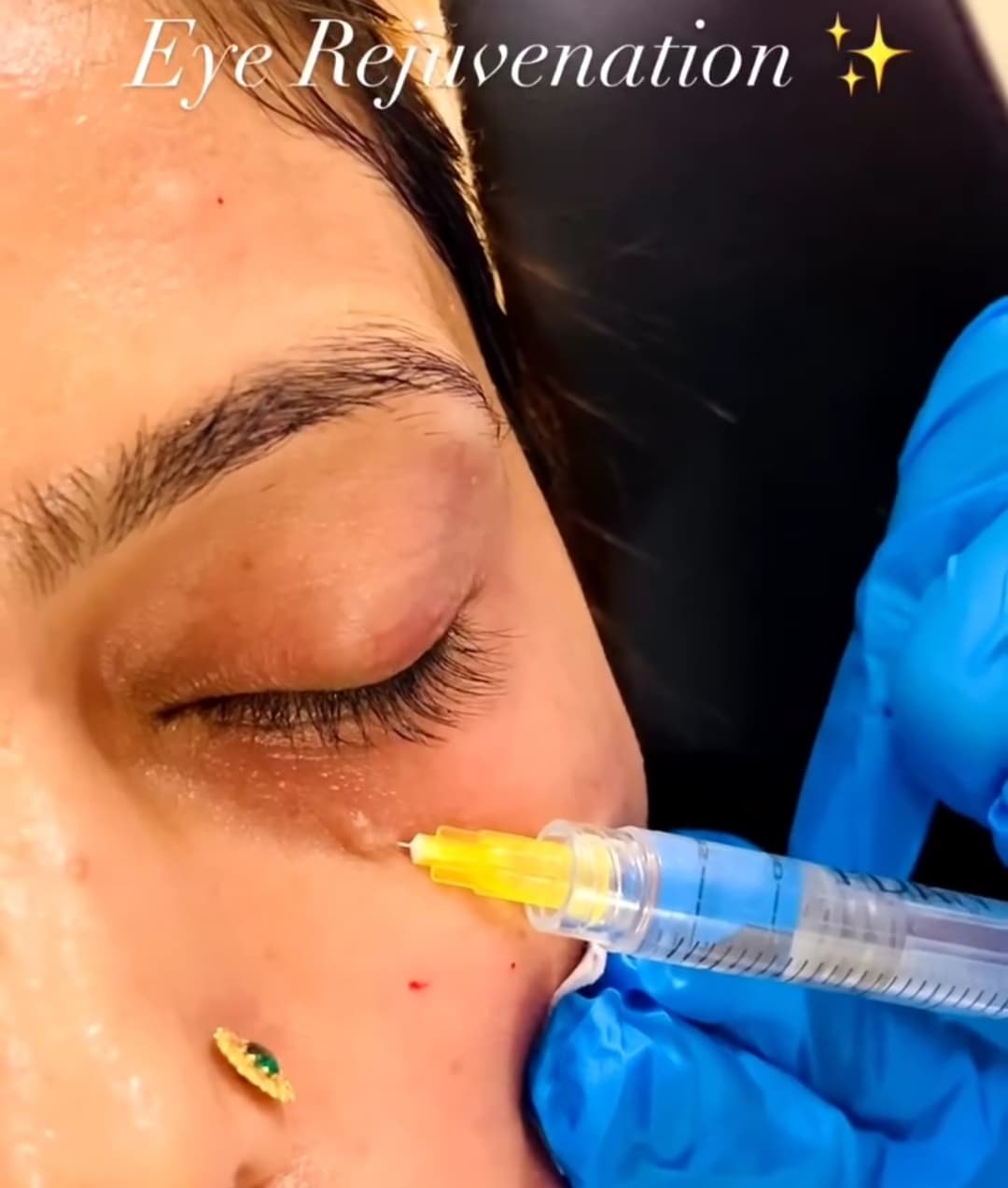 Eye Rejuvenation at B.Star Aesthetic Clinic, DHA Phase 5 Karachi