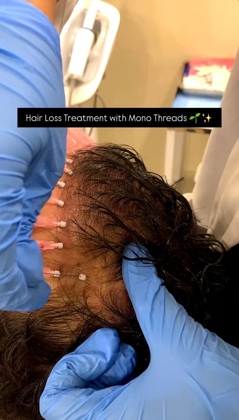 Thread Lift at B.Star Aesthetic Clinic, DHA Phase 5 Karachi