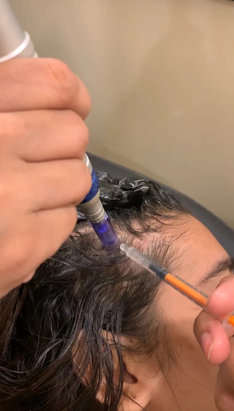 Hair PRP at B.Star Aesthetic Clinic, DHA Phase 5 Karachi