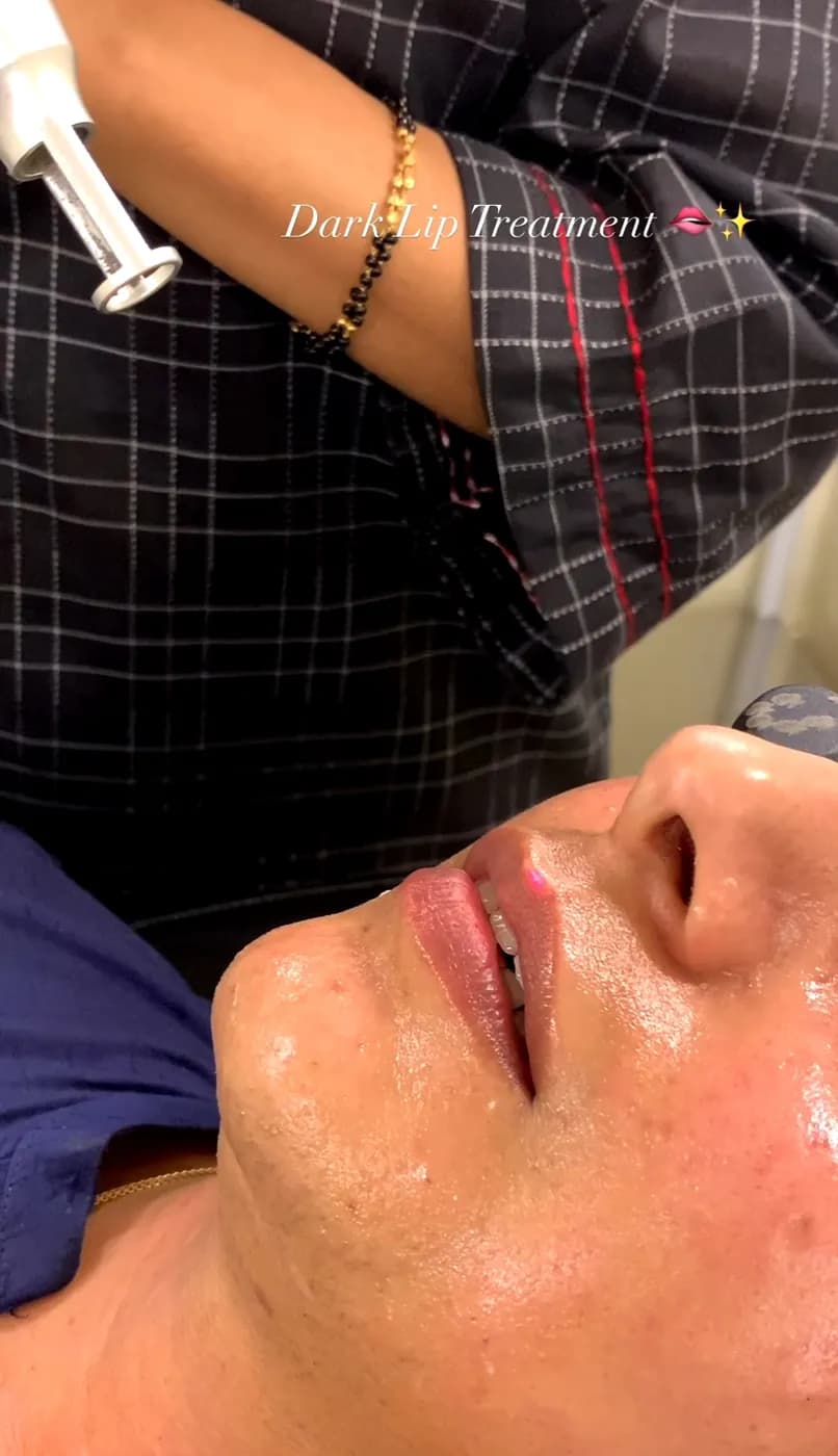 Laser for Dark Lips at B.Star Aesthetic Clinic, DHA Phase 5 Karachi